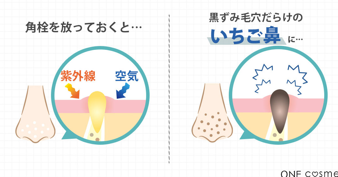 洗顔後の白い角栓はどうやって取りますか？効果的な方法
